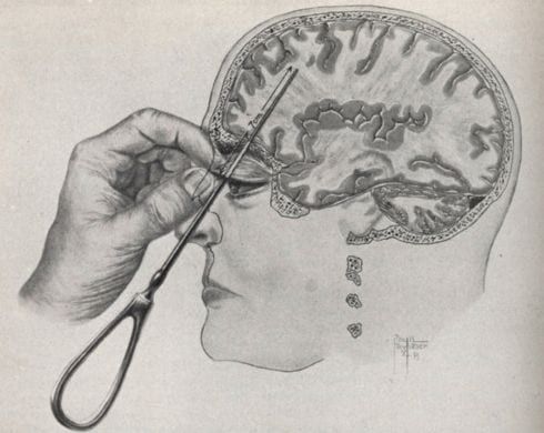 A diagram of a transorbital lobotomy, showing an instrument passed above the eye into the frontal lobe